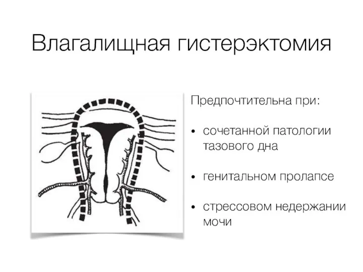 Влагалищная гистерэктомия Предпочтительна при: сочетанной патологии тазового дна генитальном пролапсе стрессовом недержании мочи