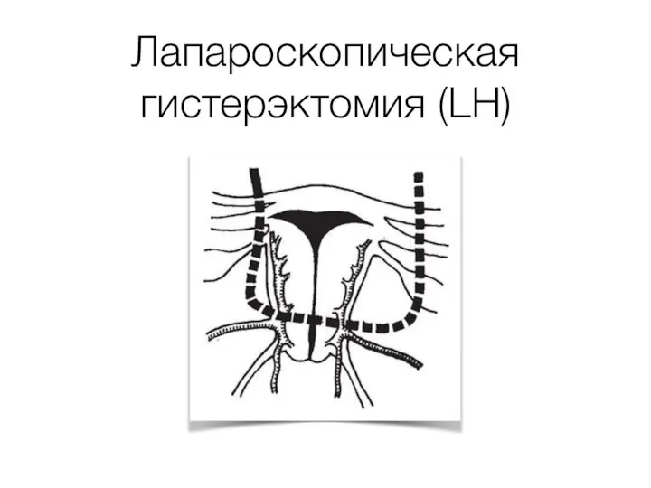 Лапароскопическая гистерэктомия (LH)