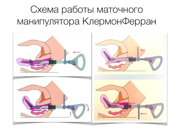 Схема работы маточного манипулятора КлермонФерран