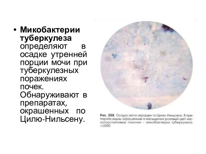 Микобактерии туберкулеза определяют в осадке утренней порции мочи при туберкулезных поражениях почек.