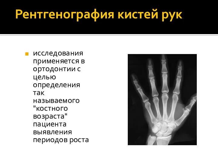 Рентгенография кистей рук исследования применяется в ортодонтии с целью определения так называемого