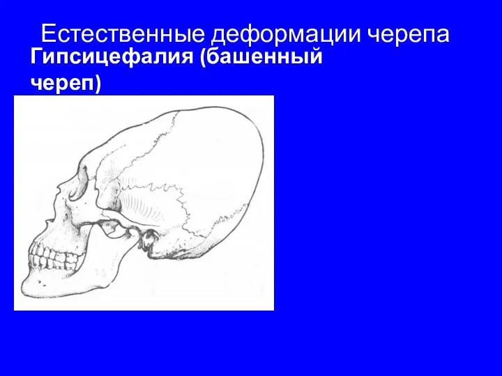 Естественные деформации черепа Гипсицефалия (башенный череп)