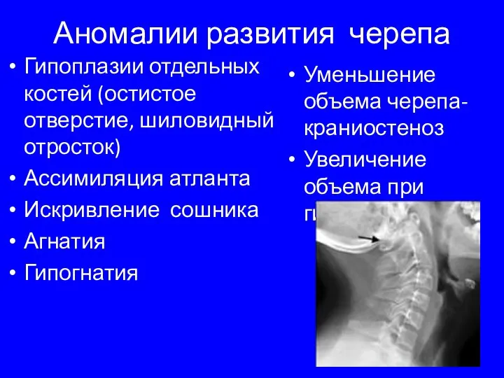 Аномалии развития черепа Гипоплазии отдельных костей (остистое отверстие, шиловидный отросток) Ассимиляция атланта