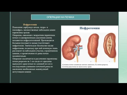 ОПЕРАЦИИ НА ПОЧКАХ Нефротомия Показания: карбункул поч­ки, гидро- и пионефроз, множественные небольшие