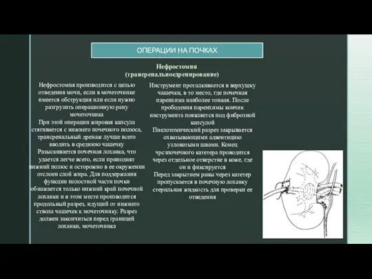 ОПЕРАЦИИ НА ПОЧКАХ Нефростомия производится с целью отведения мочи, если в мочеточнике