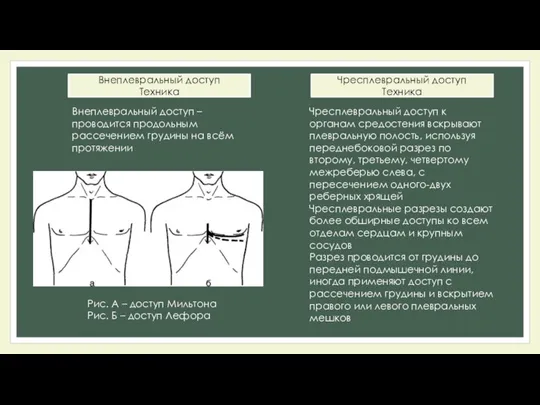 Внеплевральный доступ Техника Внеплевральный доступ – проводится продольным рассечением грудины на всём