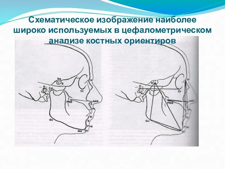 Схематическое изображение наиболее широко используемых в цефалометрическом анализе костных ориентиров