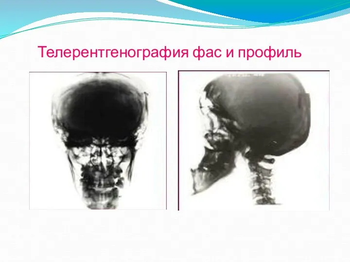 Телерентгенография фас и профиль