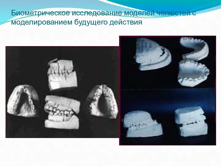 Биометрическое исследование моделей челюстей с моделированием будущего действия