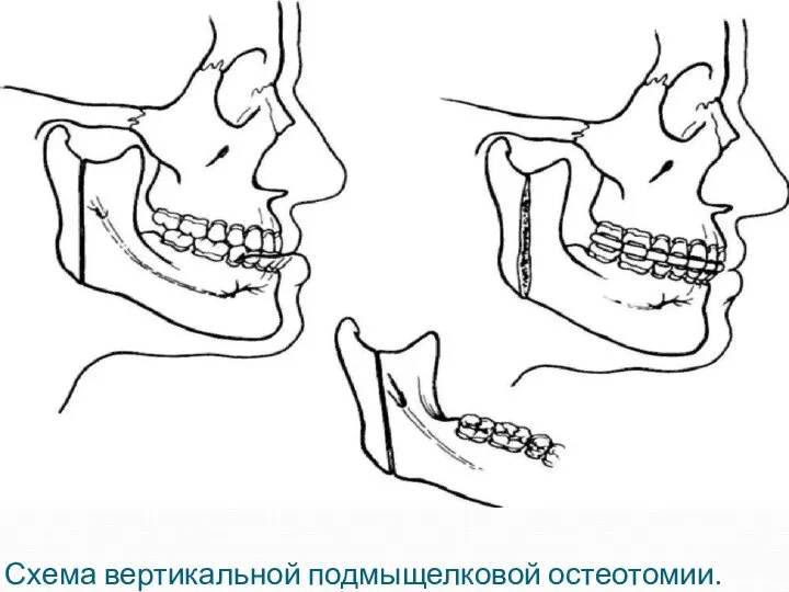 Схема вертикальной подмыщелковой остеотомии.