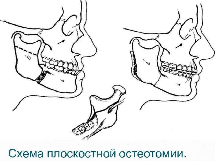 Схема плоскостной остеотомии.