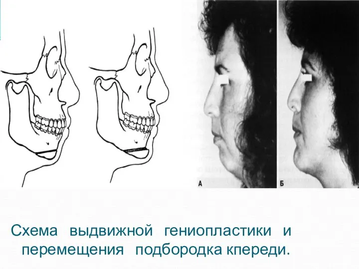 Схема выдвижной гениопластики и перемещения подбородка кпереди.