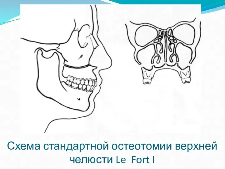 Схема стандартной остеотомии верхней челюсти Le Fort I