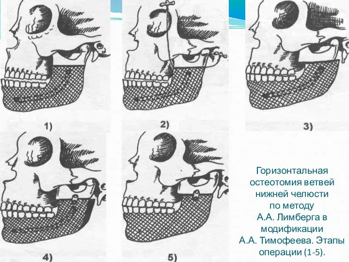 Горизонтальная остеотомия ветвей нижней челюсти по методу А.А. Лимберга в модификации А.А. Тимофеева. Этапы операции (1-5).