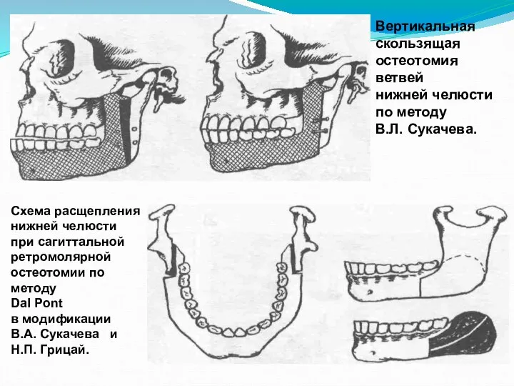 Вертикальная скользящая остеотомия ветвей нижней челюсти по методу В.Л. Сукачева. Схема расщепления