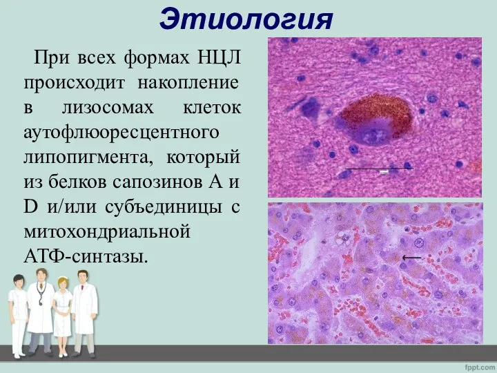 Этиология При всех формах НЦЛ происходит накопление в лизосомах клеток аутофлюоресцентного липопигмента,