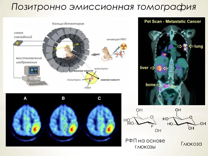 Позитронно эмиссионная томография Глюкоза РФП на основе глюкозы