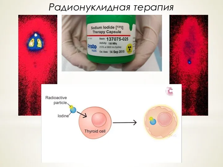 Радионуклидная терапия