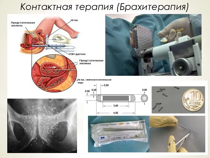 Контактная терапия (Брахитерапия)