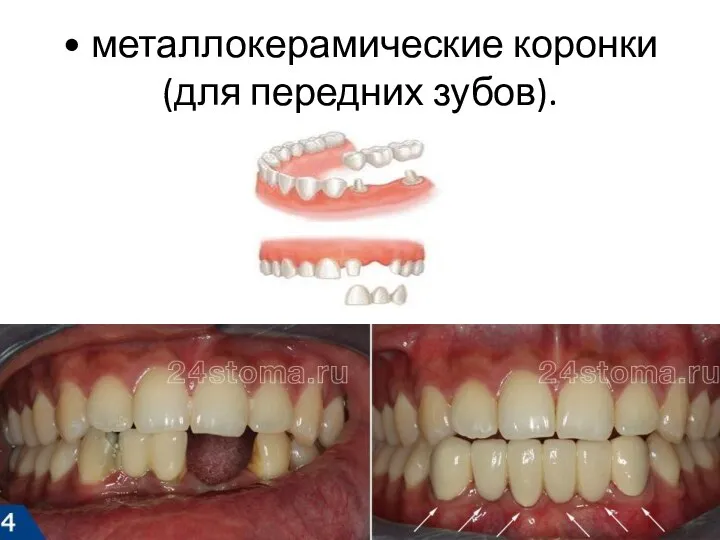 • металлокерамические коронки (для передних зубов).