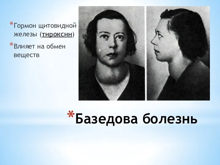 Базедова болезнь Гормон щитовидной железы (тироксин) Влияет на обмен веществ