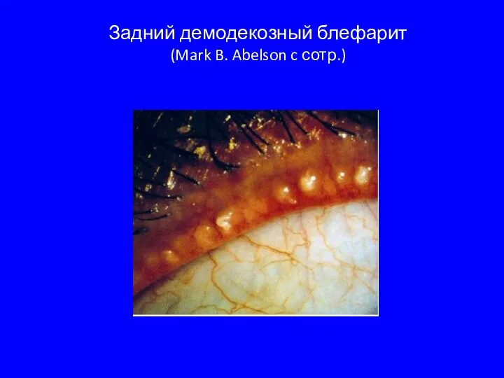 Задний демодекозный блефарит (Mark B. Abelson c сотр.)