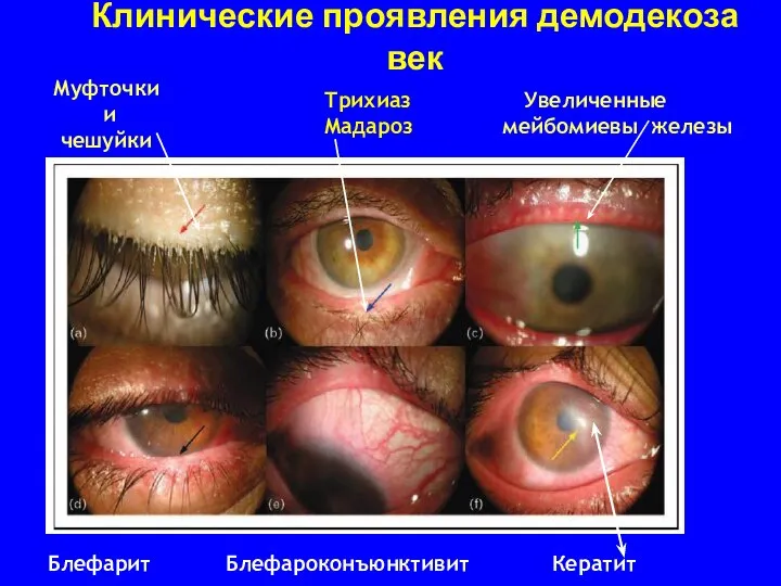 Клинические проявления демодекоза век Муфточки и чешуйки Трихиаз Мадароз Увеличенные мейбомиевы железы Блефарит Блефароконъюнктивит Кератит