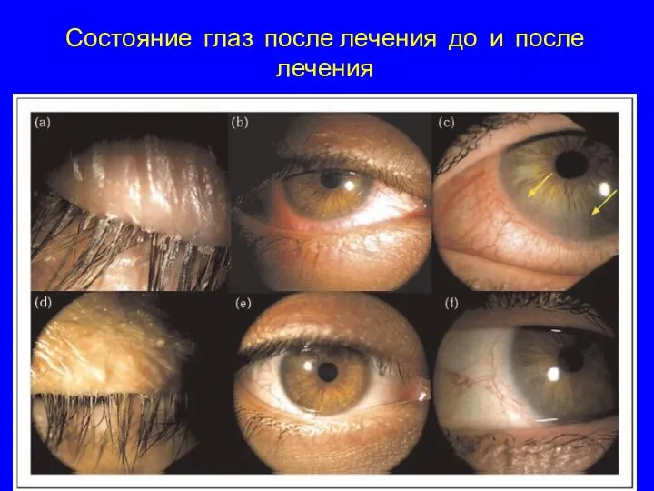 Состояние глаз после лечения до и после лечения