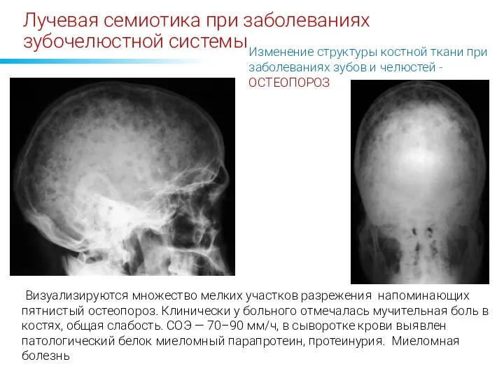 Лучевая семиотика при заболеваниях зубочелюстной системы Изменение структуры костной ткани при заболеваниях