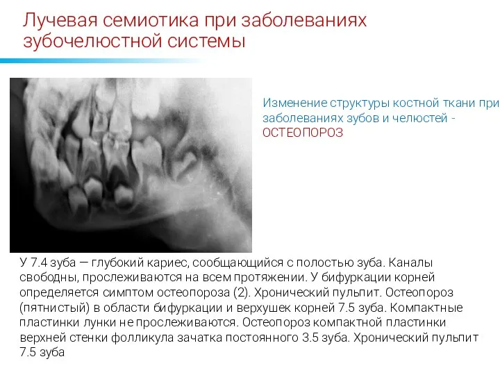 Лучевая семиотика при заболеваниях зубочелюстной системы Изменение структуры костной ткани при заболеваниях