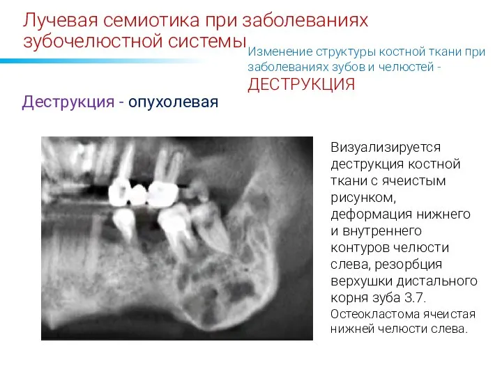 Лучевая семиотика при заболеваниях зубочелюстной системы Изменение структуры костной ткани при заболеваниях