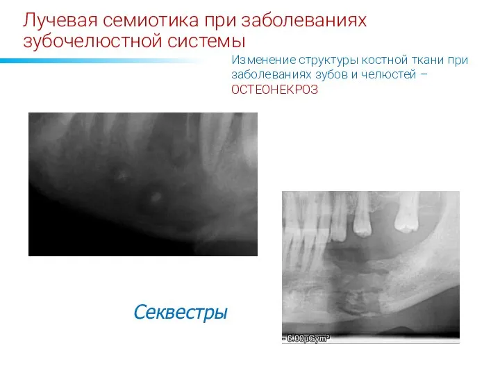 Лучевая семиотика при заболеваниях зубочелюстной системы Секвестры Изменение структуры костной ткани при