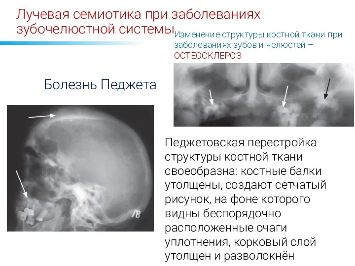 Лучевая семиотика при заболеваниях зубочелюстной системы Изменение структуры костной ткани при заболеваниях