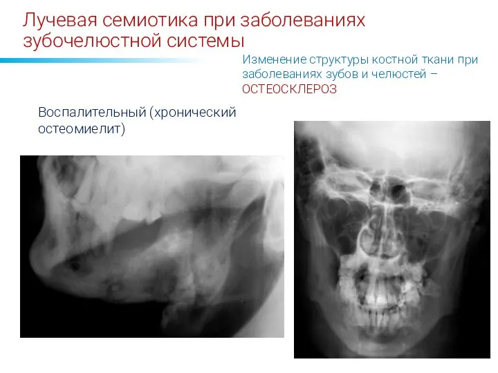 Лучевая семиотика при заболеваниях зубочелюстной системы Изменение структуры костной ткани при заболеваниях