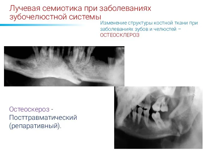 Лучевая семиотика при заболеваниях зубочелюстной системы Изменение структуры костной ткани при заболеваниях