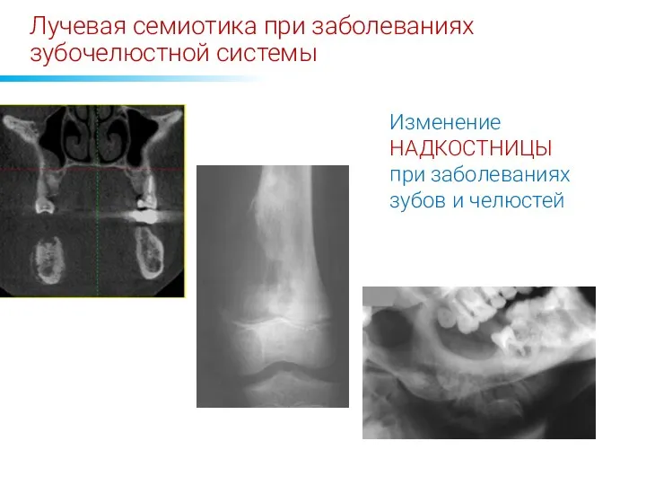 Лучевая семиотика при заболеваниях зубочелюстной системы Изменение НАДКОСТНИЦЫ при заболеваниях зубов и челюстей