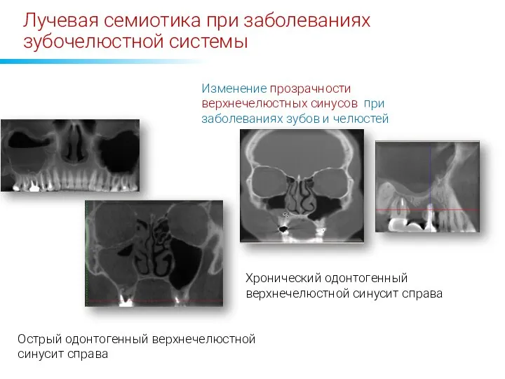 Лучевая семиотика при заболеваниях зубочелюстной системы Изменение прозрачности верхнечелюстных синусов при заболеваниях