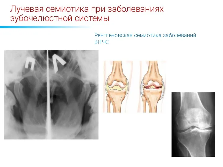 Лучевая семиотика при заболеваниях зубочелюстной системы Рентгеновская семиотика заболеваний ВНЧС