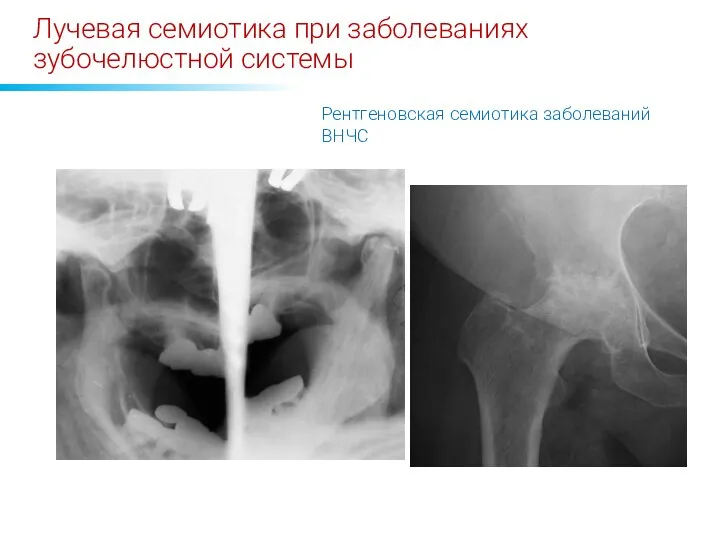 Лучевая семиотика при заболеваниях зубочелюстной системы Рентгеновская семиотика заболеваний ВНЧС