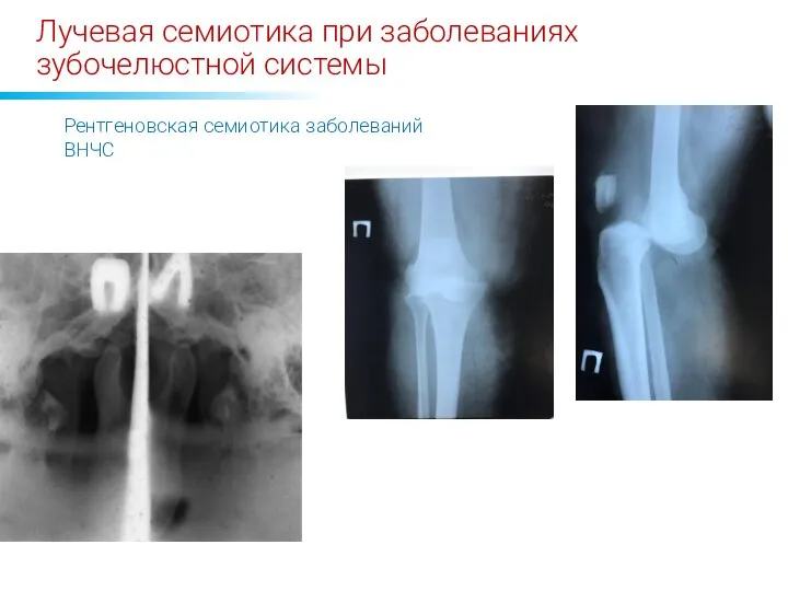 Лучевая семиотика при заболеваниях зубочелюстной системы Рентгеновская семиотика заболеваний ВНЧС