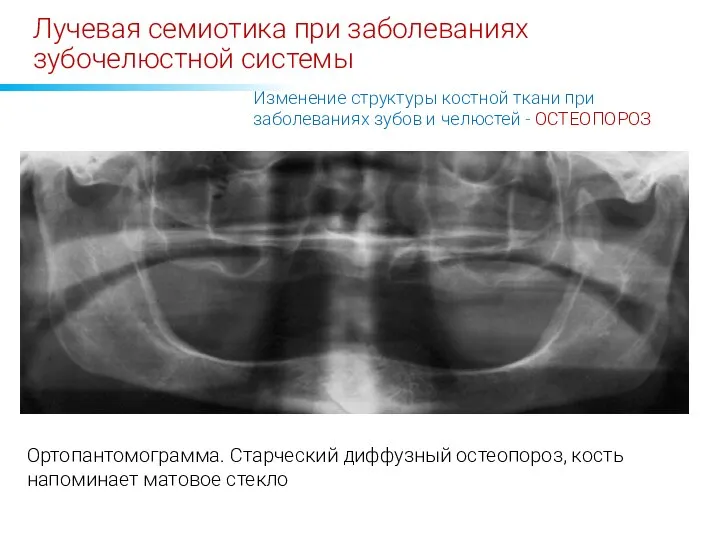 Лучевая семиотика при заболеваниях зубочелюстной системы Ортопантомограмма. Старческий диффузный остеопороз, кость напоминает
