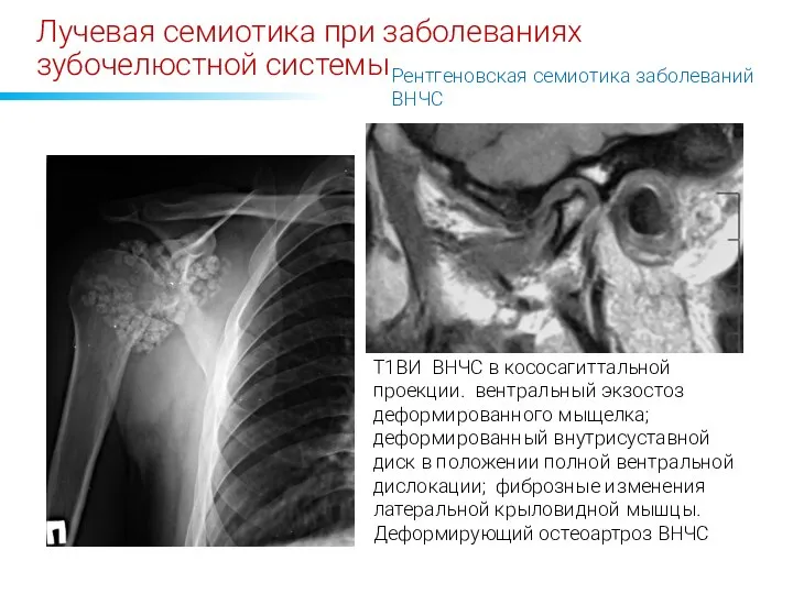 Лучевая семиотика при заболеваниях зубочелюстной системы Т1ВИ ВНЧС в кососагиттальной проекции. вентральный