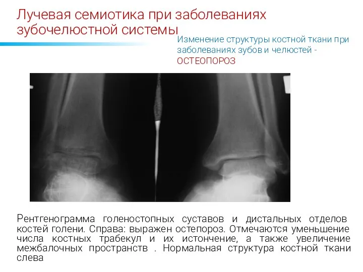 Лучевая семиотика при заболеваниях зубочелюстной системы Изменение структуры костной ткани при заболеваниях