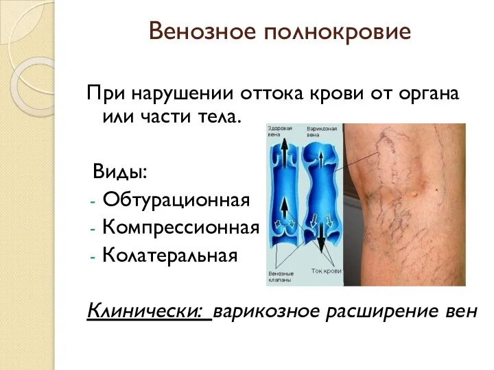 Венозное полнокровие При нарушении оттока крови от органа или части тела. Виды: