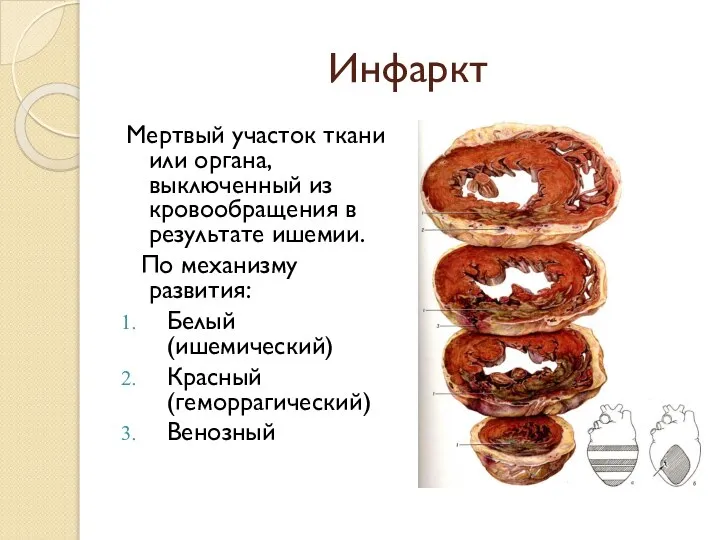 Инфаркт Мертвый участок ткани или органа, выключенный из кровообращения в результате ишемии.