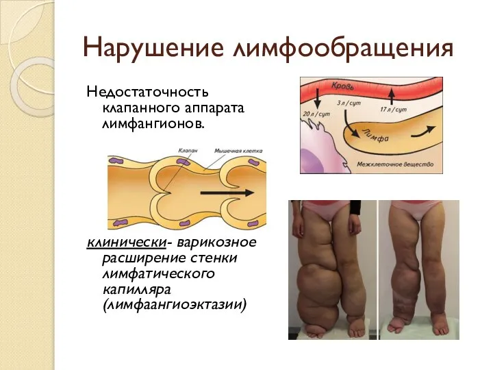 Нарушение лимфообращения Недостаточность клапанного аппарата лимфангионов. клинически- варикозное расширение стенки лимфатического капилляра (лимфаангиоэктазии)