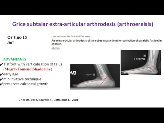 Grice subtalar extra-articular arthrodesis (arthroereisis) От 5 до 10 лет ADVANTAGES: flatfoot