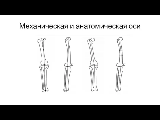 Механическая и анатомическая оси