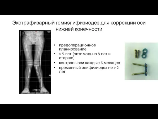 Экстрафизарный гемиэпифизиодез для коррекции оси нижней конечности предоперационное планирование > 5 лет