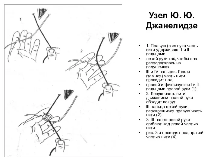 Узел Ю. Ю. Джанелидзе 1. Правую (светлую) часть нити удерживают I и